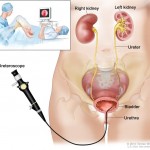 Cystoscopy 