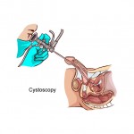 cystoscopy_shutterstock_42731590