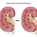 Lithotripsy Kidney Stones
