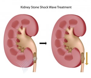 Lithotripsy Kidney Stones