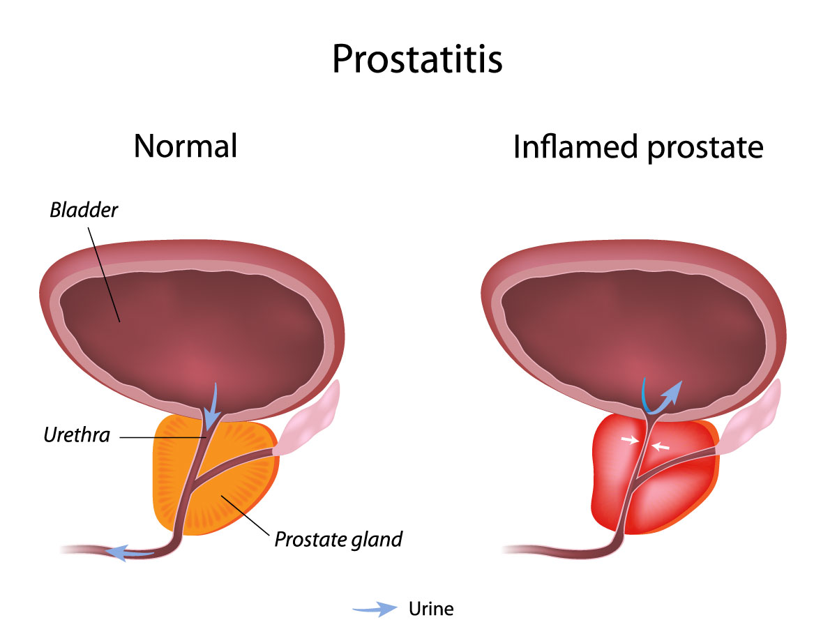 Prostatitis kezelése Ayurveda- n dimensiunea prostatei normale