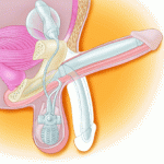 penile_prosthesis_5807